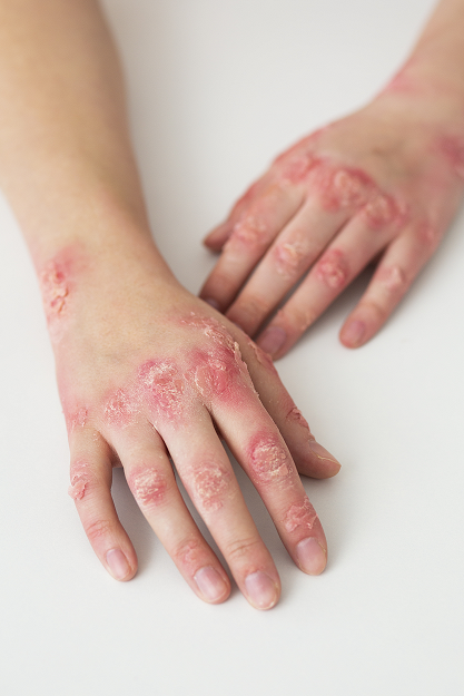 Psoriasis